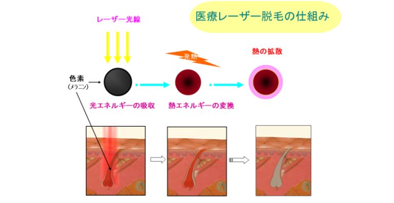 医療脱毛の原理2