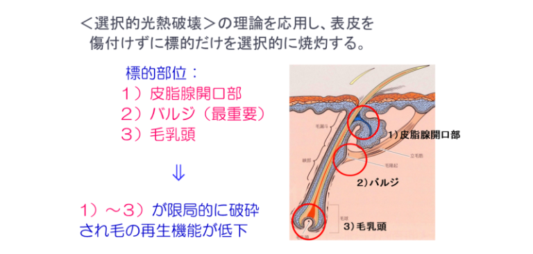 医療脱毛の原理1