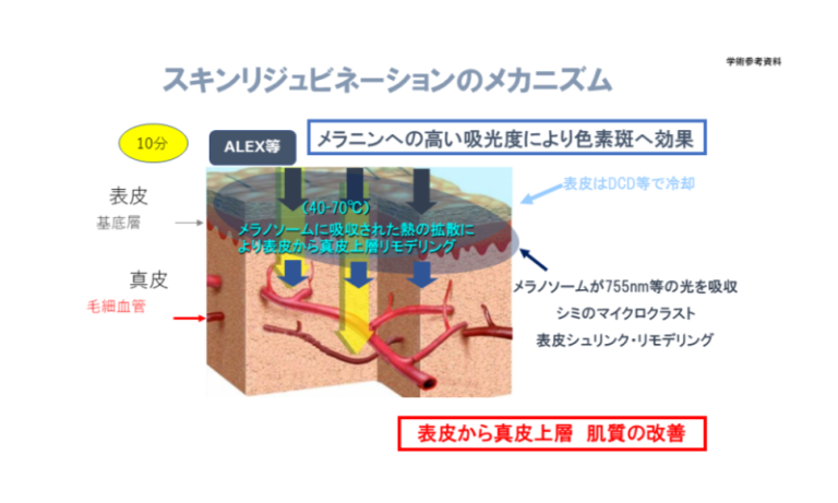 新橋・有楽町・銀座・汐留でシミ取り治療・そばかす治療を提供している新橋駅前眼科皮膚科、しみ治療・そばかす治療イメージ図